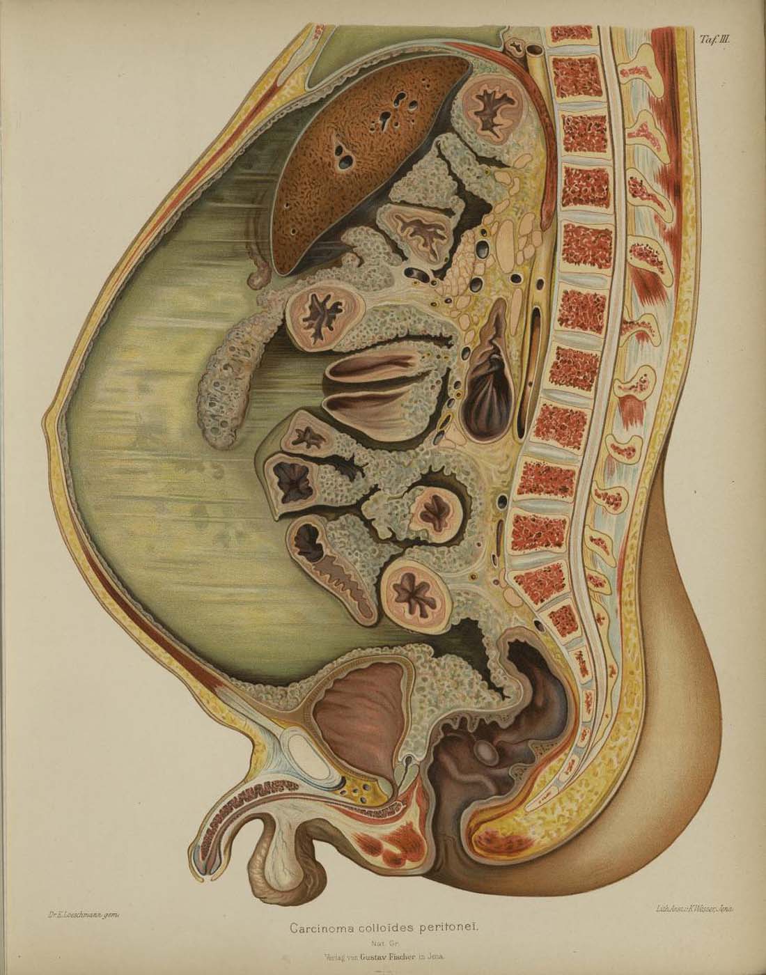 Carcinoma colloides peritonei Die farbige Abbildung zeigt einen vertikalen Querschnitt der Bauchhöhle mit ihren Organen und der Wirbelsäule. Sie füllt die gesamte Seite aus. Auf dem schmalen Rand rechts oben steht in lateinischen Buchstaben Taf. 3. Am unteren Rand ist zentriert in blasser gedruckter Schrift der Titel der Zeichnung lesbar. Die Darstellung beginnt am oberen Seitenrand unterhalb des Brustkorbs und endet unten mit dem Po und männlichen Geschlechtsorganen. Rechts ist sie durch die Wirbelsäule begrenzt, links durch den stark vorgewölbten Bauch. Umgeben wird die Abbildung von einen beige-gelblichen Rand. Die Wirbelsäule schwingt im Lendenbereich etwas nach links. Die einzelnen Wirbel sind in einem hellem Gelb dargestellt, rote Pünktchen dicht nebeneinander markieren ihr Inneres. In Hellblau erscheinen die Räume dazwischen. Nach links folgt die Abbildung der Bauchhöhle mit ihren Organen. Sie sind mehrheitlich in einem blassen Rot gezeichnet. Blassgelbe Umrandungen konturieren sie nach außen. Alle Organe sind dazu mehr oder weniger von grauer Farbe umgeben. Sie erscheint wie ein Belag, dessen Struktur an Kaviar erinnert. Im oberen Drittel sticht eine ovale braune Fläche hervor, auf der unterschiedlich große dunkle Punkte erscheinen. Darunter, nah an der Wirbelsäule befindet sich eine längliche, vertikal verlaufende Farbfläche in Gelb, deren Enden sich verjüngen. Darin ist ein dunkelbraunes Oval abgebildet. Der Raum hinter der Wölbung der Bauchdecke links ist mit blasser grün-grauer Farbe ausgemalt. Diese Abbildung stammt aus dem Topographischen Atlas der Medizinisch-Chirurgischen Diagnostik, der vom Pathologen Emil Ponfick zwischen 1900 und 1905 zusammengestellt wurde. Unterstützt wurde er dabei von Dr. Emil Löschmann, einem Maler und Grafiker aus Breslau. — — Carcinoma colloides peritonei The coloured illustration shows a vertical cross-section of the abdominal cavity with its organs and spine. It fills the entire page. On the narrow margin in the upper right corner, “Taf. 3” is written in Latin letters. The title of the drawing can be read at the lower margin, centred in a pale printed script. The illustration begins at the top of the page below the ribcage and ends at the bottom with the buttocks and male sexual organs. On the right, it is limited by the spine, and on the left by the strongly bulging abdomen. The figure is surrounded by a beige-yellowish border. The spine swings slightly to the left in the lumbar region. The individual vertebrae are depicted in light yellow, red dots close together mark their interior. The spaces between them appear in light blue. To the left follows the illustration of the abdominal cavity with its organs. The majority of them are drawn in pale red. Pale yellow borders outline them on the outside. All organs are more or less surrounded by a grey colour. It appears like a coating whose structure is reminiscent of caviar. In the upper third, an oval brown area stands out, on which dark dots of different sizes appear. Below it, close to the spine, is an elongated vertically running coloured area in yellow, the ends of which taper off. A dark brown oval is depicted within it. The space behind the bulge of the abdominal wall on the left is painted in a paler green-grey colour. This illustration is from the "Topographical Atlas of Medico-Surgical Diagnostics," compiled by the pathologist Emil Ponfick between 1900 and 1905. He was assisted by Dr. Emil Löschmann, a painter and graphic artist from Breslau.